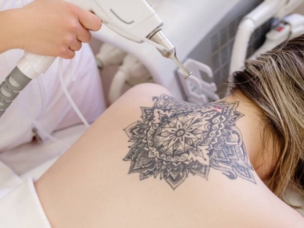 rimozione tatuaggi