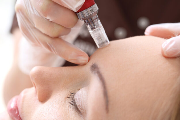 mesoterapia